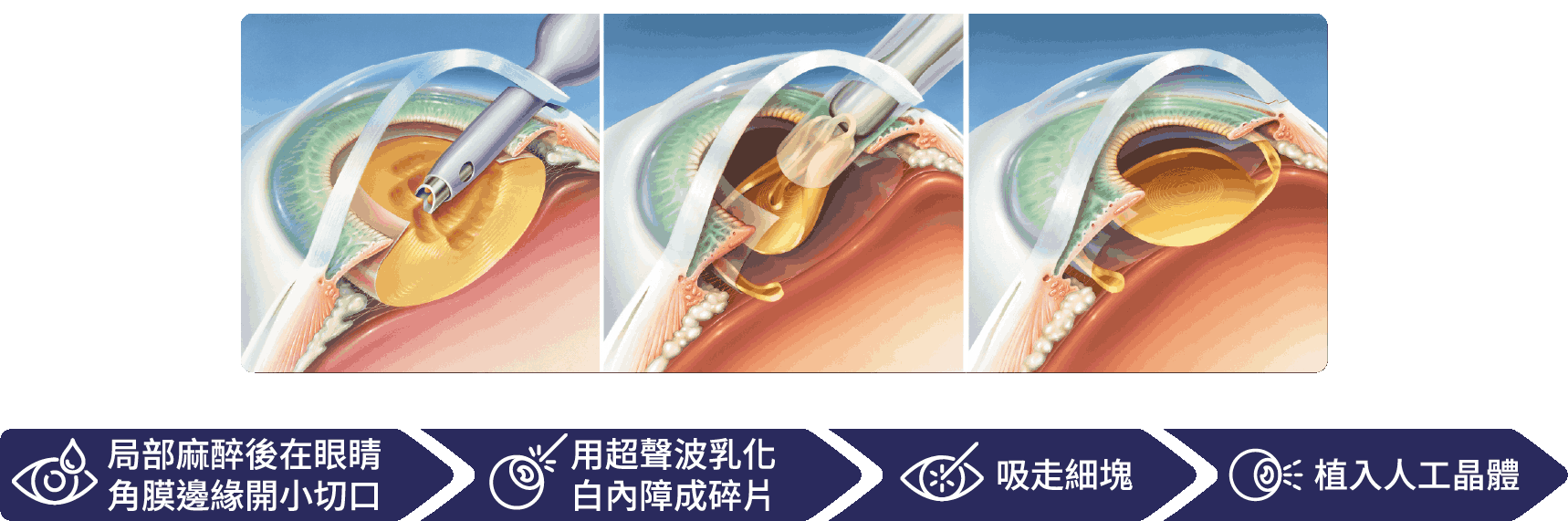 超聲波白內障手術過程